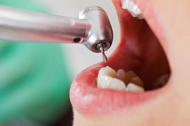 Best Emergency Tooth Extraction in Biggs, CA